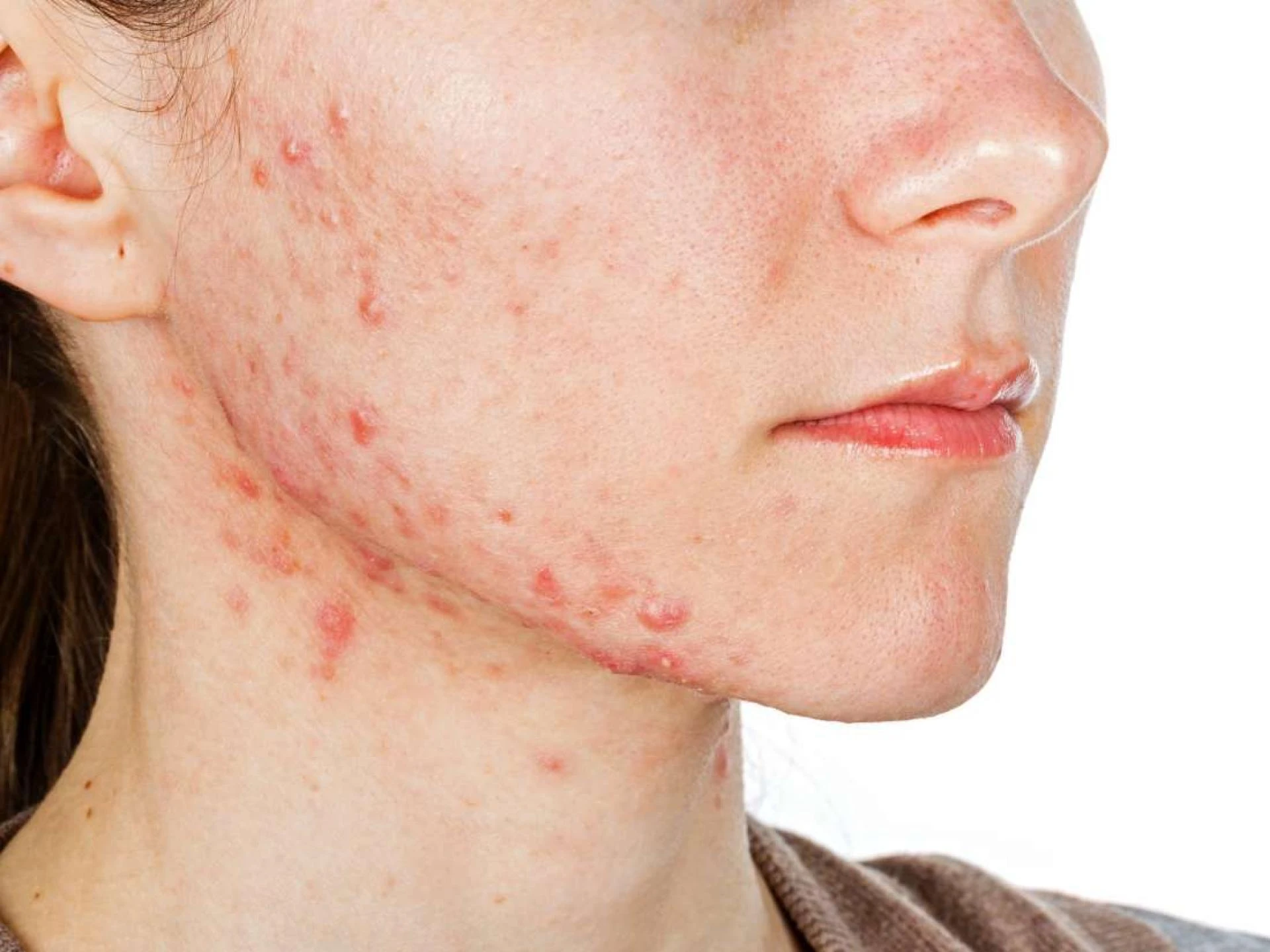 This Is How You Really Get Rid Of Acne Scars