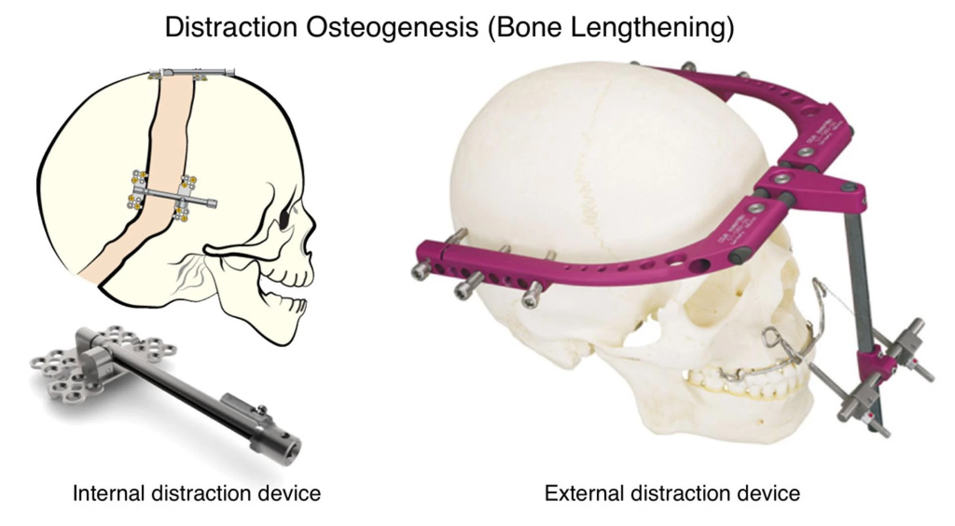 Distraction Osteogenesis Devices Market by 2030 Business Overview, Manufacturers Profile, Type, Application, Strategic Business Planning