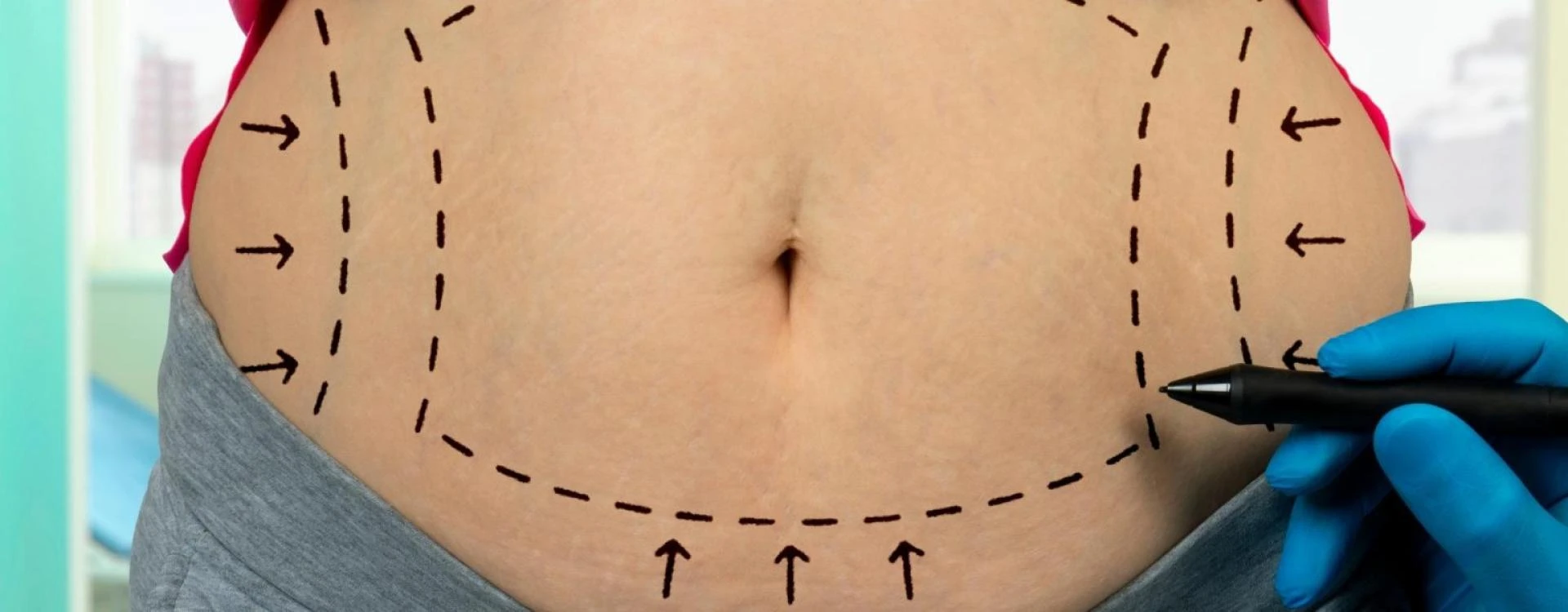Does Fat Return After Liposuction?