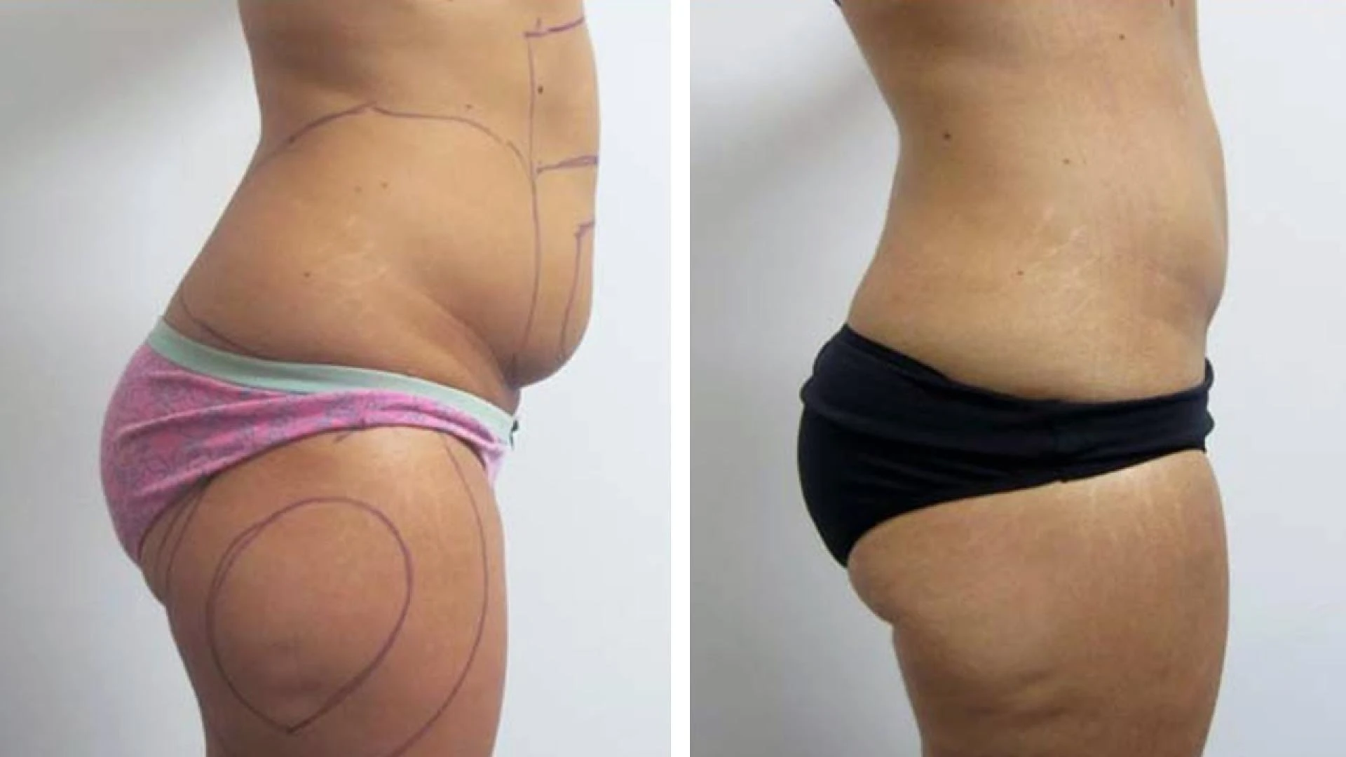 Liposuction Cost in India: To Know the Price