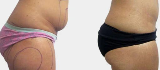 Does Fat Return After Liposuction?