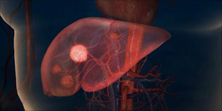 The Role of CBD Oil in Liver Cancer Treatment