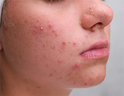 Acne in Different Weather Conditions: Summer, Winter, and Humidity