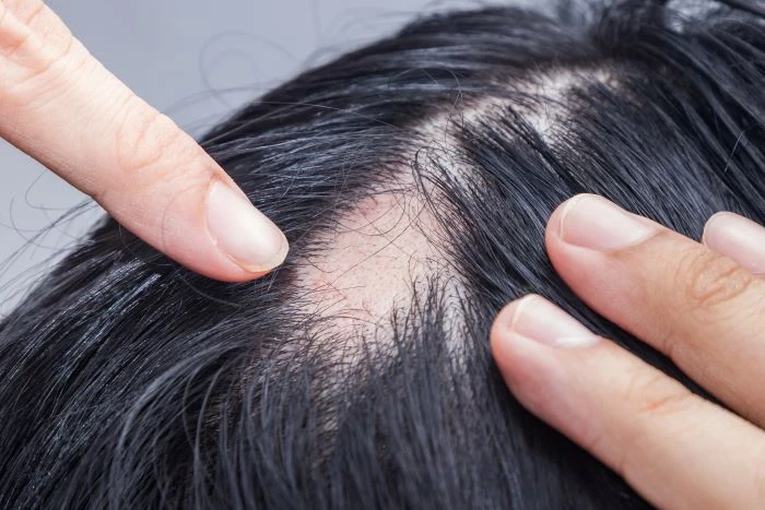 Discover the Advantages of Alopecia Areata Treatment in Pune