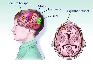 Best Parkinsons Disease Doctors in Gurgaon