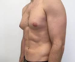 Gynecomastia Surgery