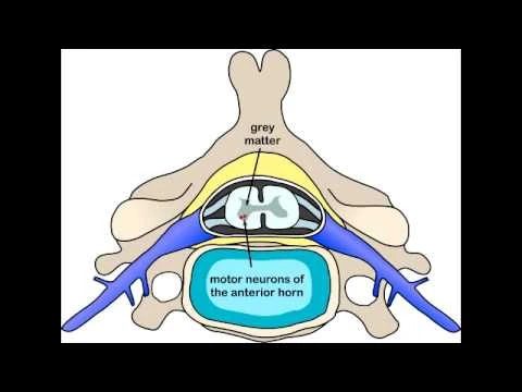 Global Spinal Muscular Atrophy Market Is Estimated To Witness High Growth Owing To Advanced Therapeutics Development