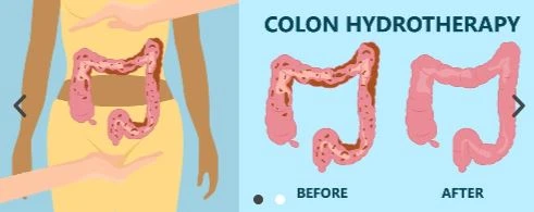 A Home Remedy for Cleansing the Colon Irrigation Croydon Naturally