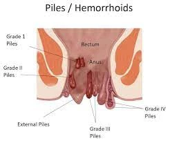 Piles removal surgery in Singapore ?