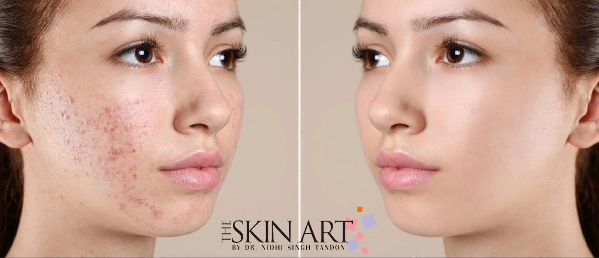 Dr Nidhi Singh Tandon is the Best Skin Specialist in Lucknow