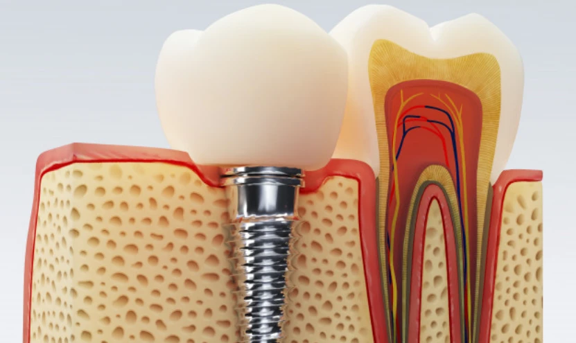 Get Sparkling White Tooth Which will Enhance your Beauty!!