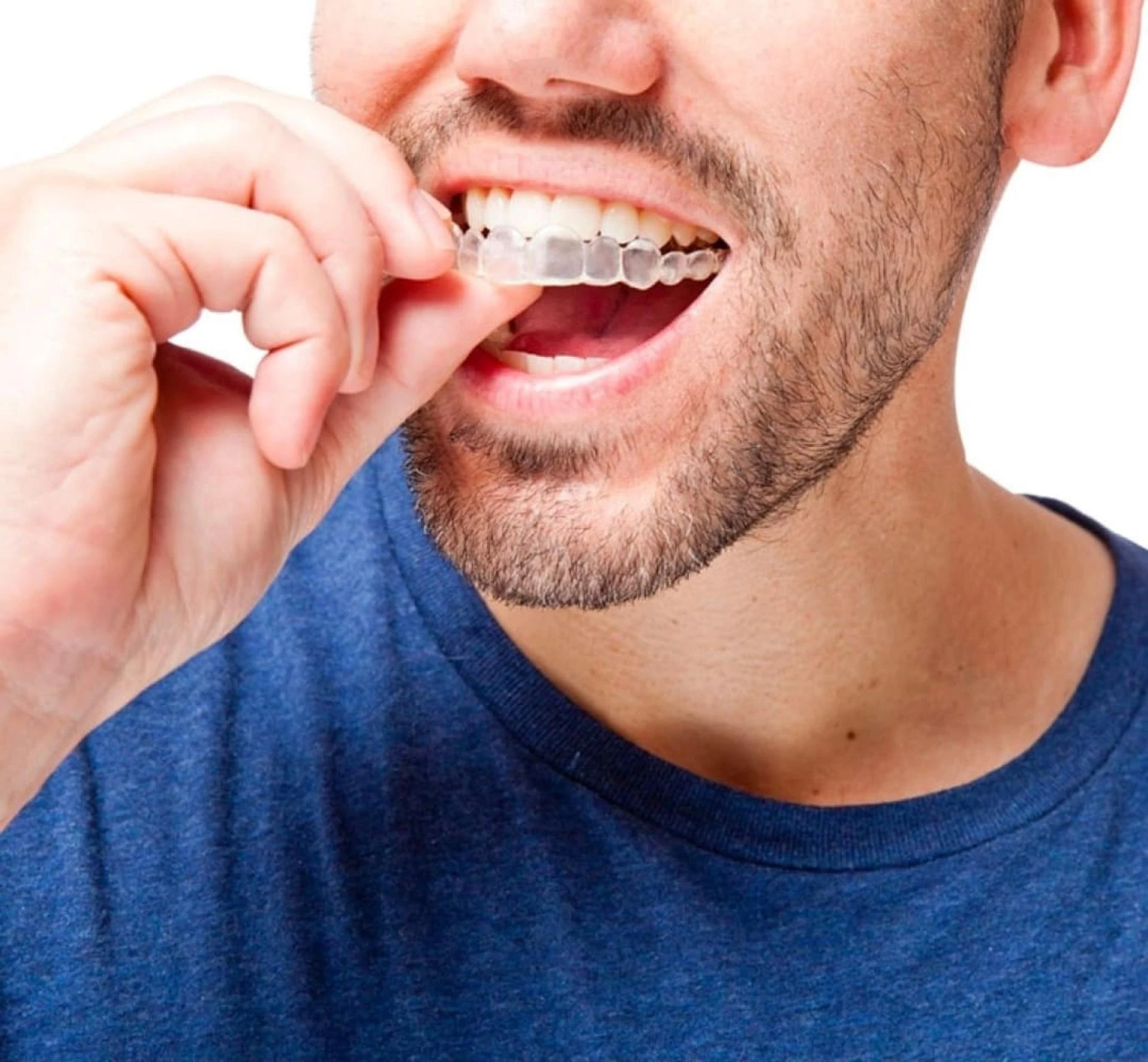 Invisalign: How to get the smile you've always wanted
