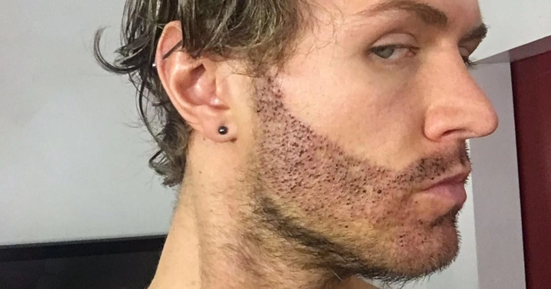 Beard Goals: The Riyadh Edition – Your Guide to Hair Transplant Success