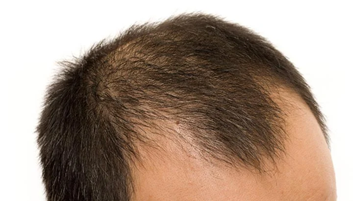 Say Goodbye to Baldness: Revolutionary Treatments for Men in Saudi Arabia!