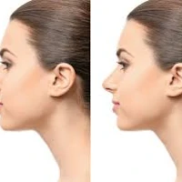 Enhancing Beauty and Confidence: The Art of Rhinoplasty in Saudi Arabia