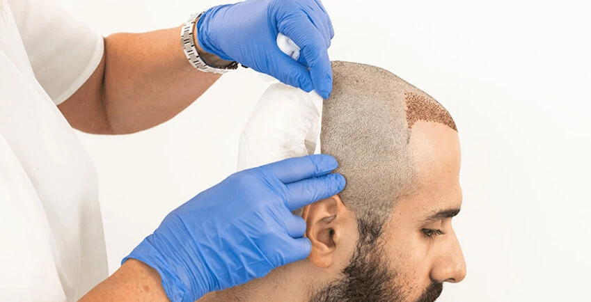 Hair Transplant Gone Wrong: Signs, Causes &amp; Solutions