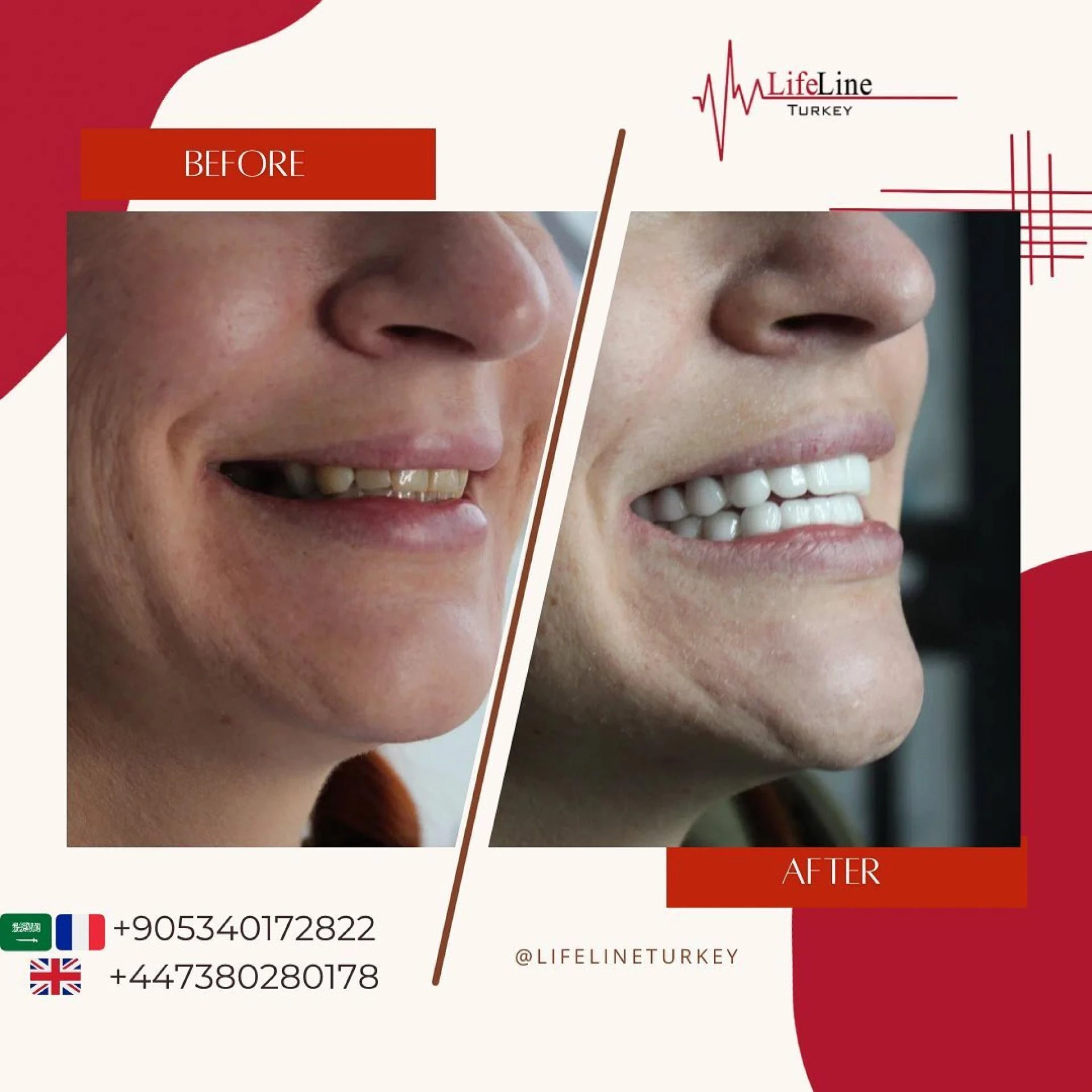 How to find the right Dental Clinic in Turkey?