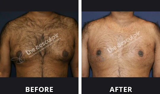 Your Trusted Partner for Gynecomastia Surgery in Delhi
