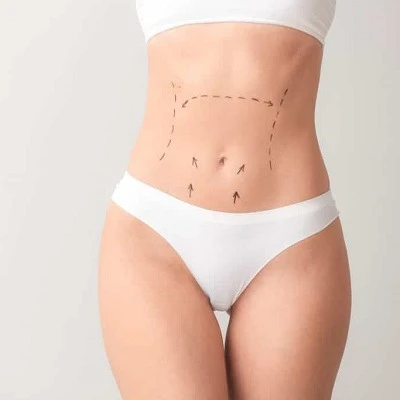 Exploring Mini Abdominoplasty: What You Need to Know
