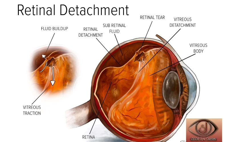 Preserving Your Sight: The Importance of Early Diagnosis and Treatment of Retinal Detachment