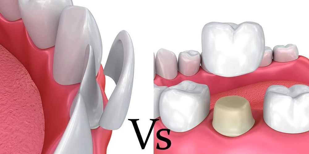 Veneers vs. Crowns: Choosing the Right Option for Your Teeth