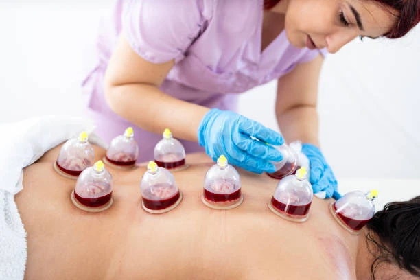 Cupping Treatment in Riyadh: Your Guide to Ultimate Healing