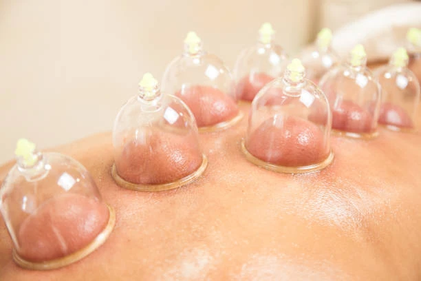 Find Relief: Top Cupping Treatment in Riyadh