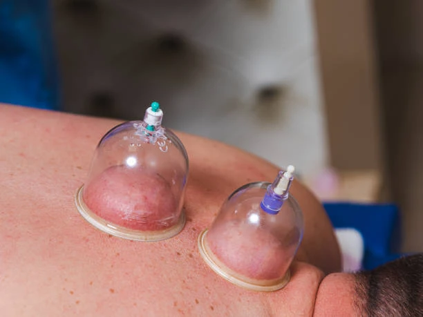 Transform Your Well-being with Cupping Treatment in Riyadh
