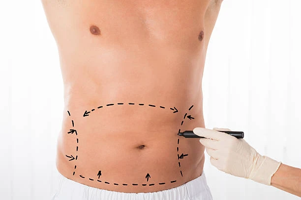 Empower Your Confidence: Abdominoplasty in Riyadh