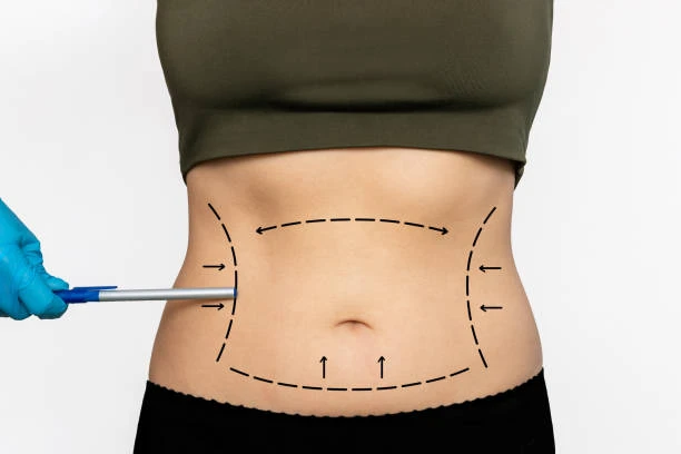 Sculpt Your Destiny: Liposuction Services in Riyadh