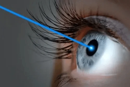 Contoura Vision Surgery