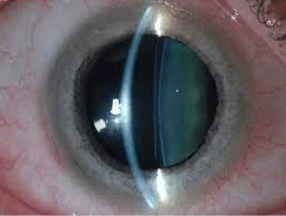 ICL Eye Surgery