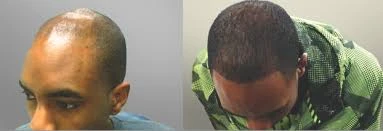 Laser hair replacement therapy