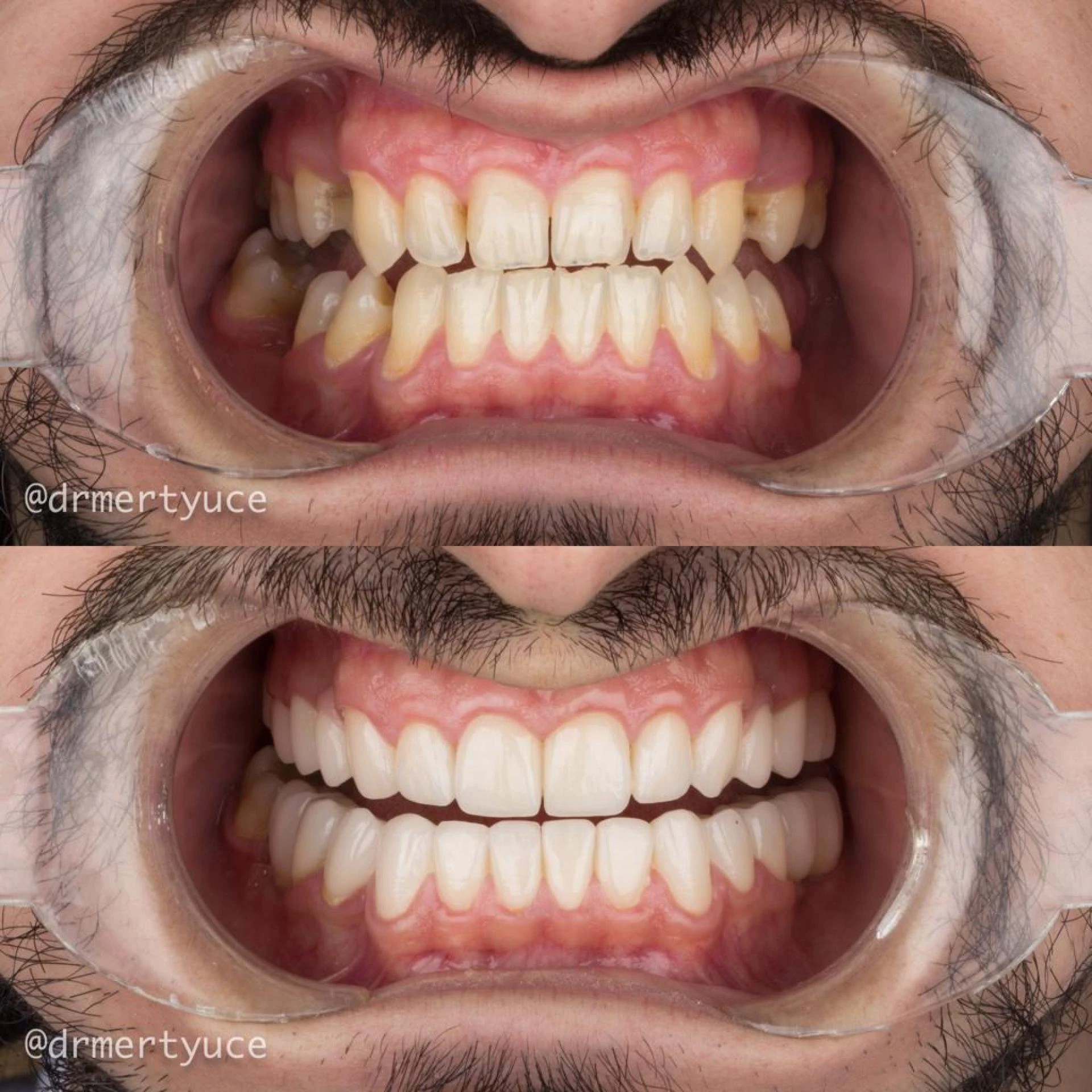 Transform Your Smile with Professional Teeth Whitening Services in Istanbul