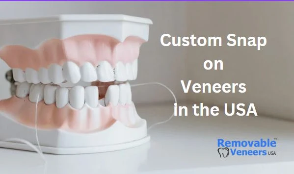 Reasons Why Custom Snap on Veneers are so Popular