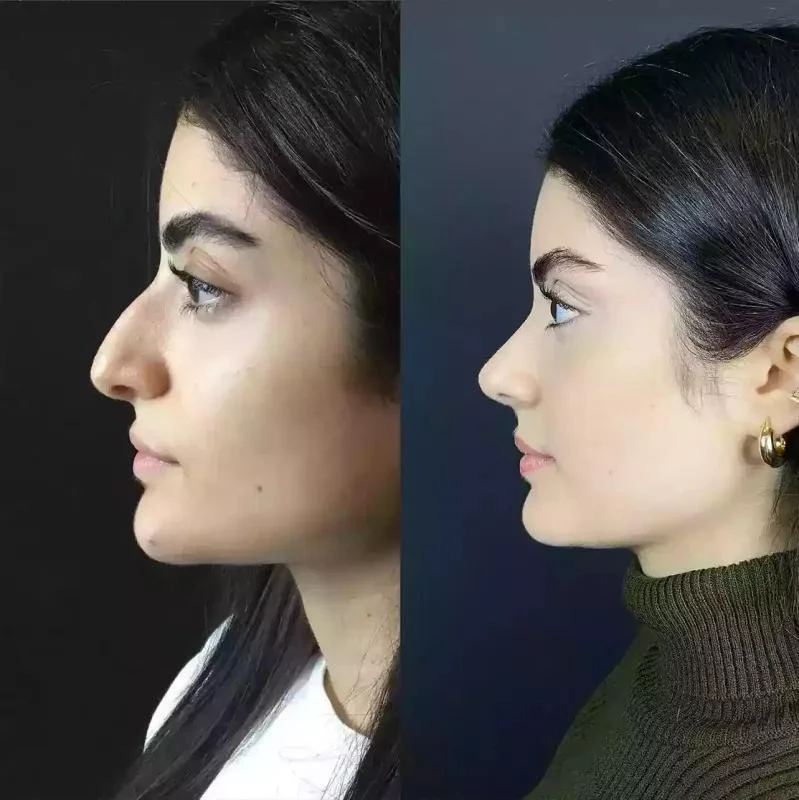 The Dubai Dream Nose: Enhancing Beauty Through Rhinoplasty