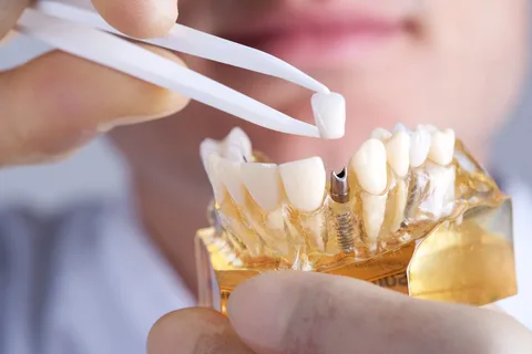 Revolutionizing Smiles: Dental Implants and Prosthetics Market Growth Forecast 2024-2032
