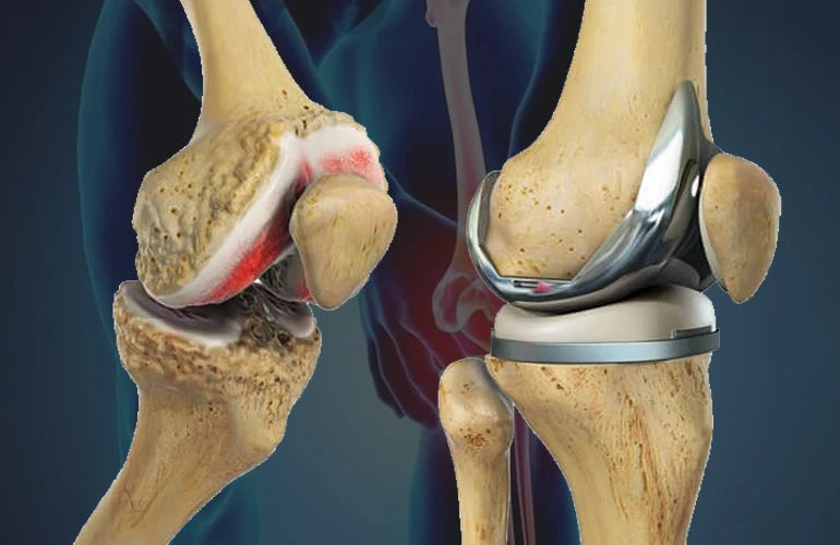 Breaking Boundaries: Redefining Mobility with Knee Replacement