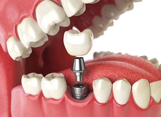 5 Steps to a Successful Dental Implant Procedure: What You Need to Know