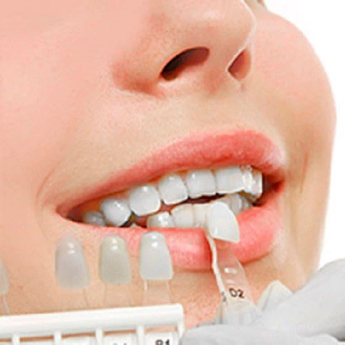 The Importance of Veneers: Reasons You Need Them