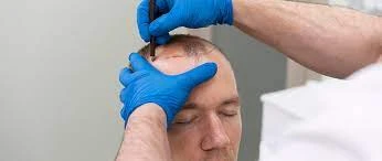 Hair Transplants in Dubai – Types, Procedure, Recovery Time