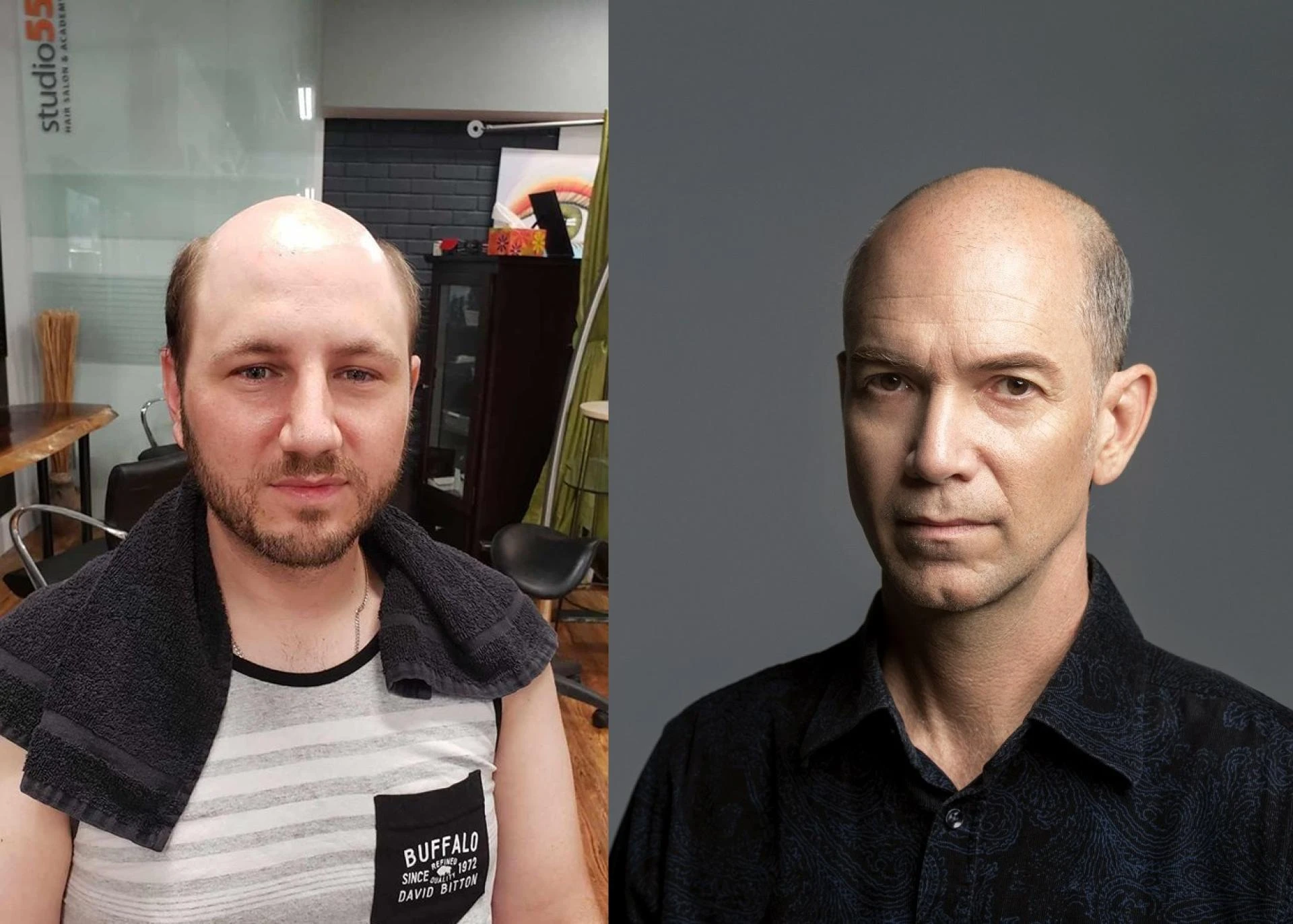 The best treatment for men's hair loss