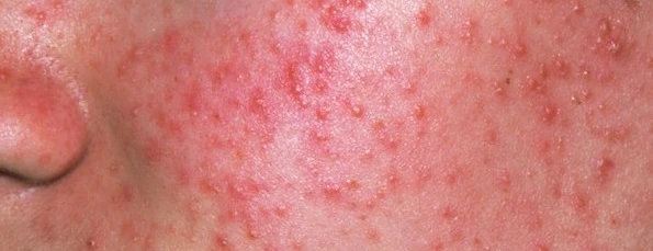 9 Common Myths Debunked About Acne Treatment