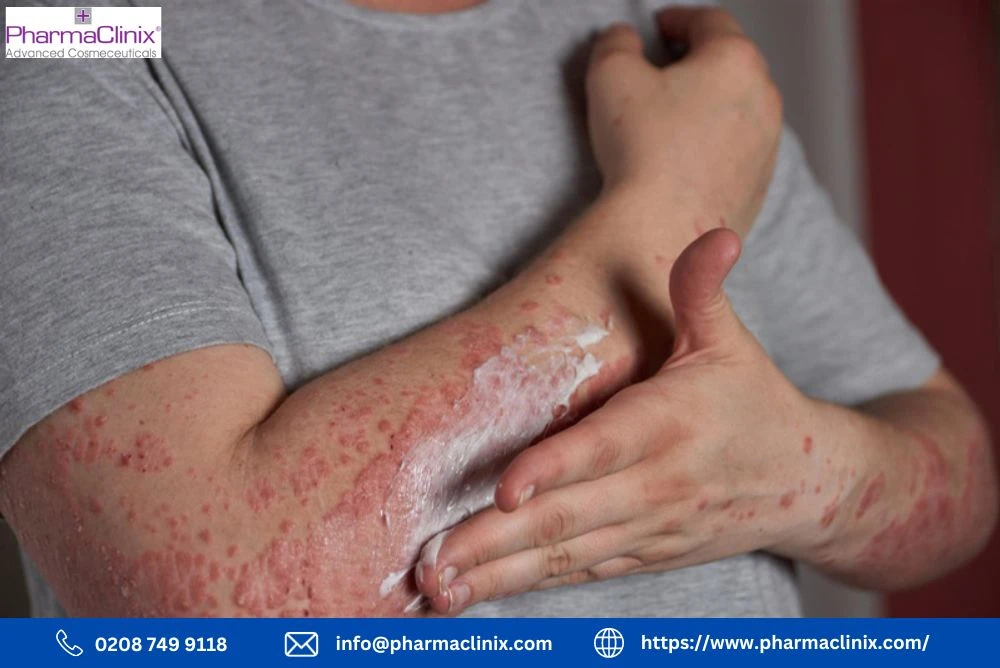 Unveiling the Hidden Struggle: Understanding Post Inflammatory Hyperpigmentation Eczema