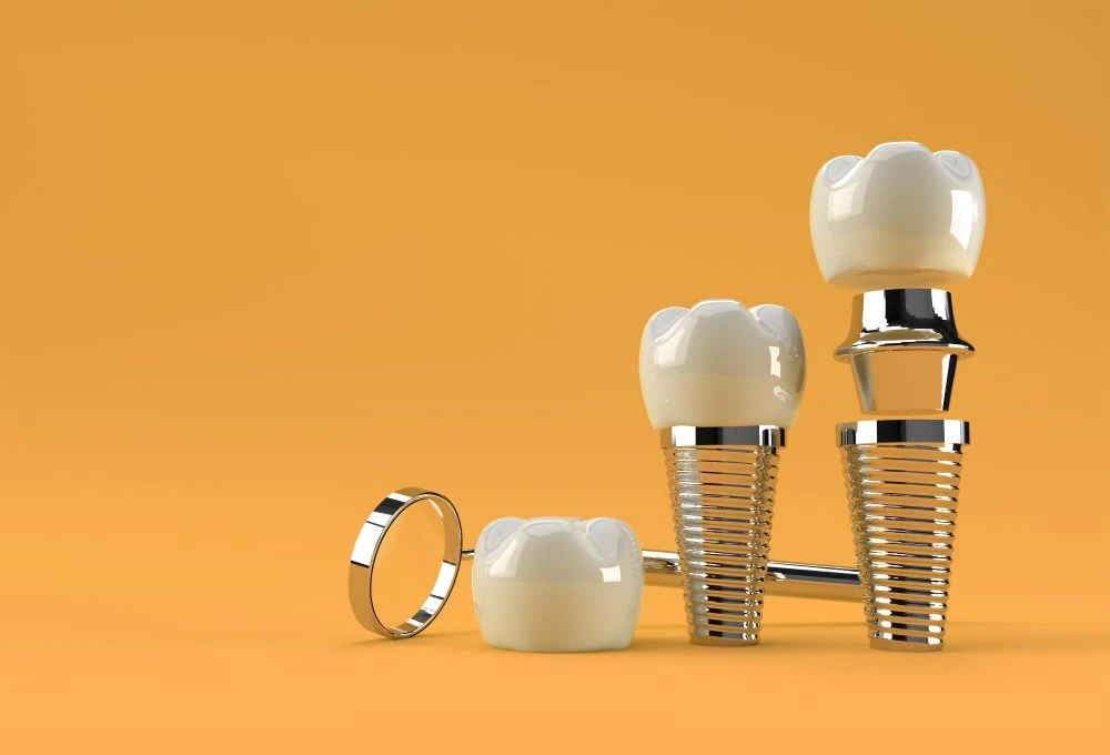 Can You Get Dental Implants with Gum Disease?