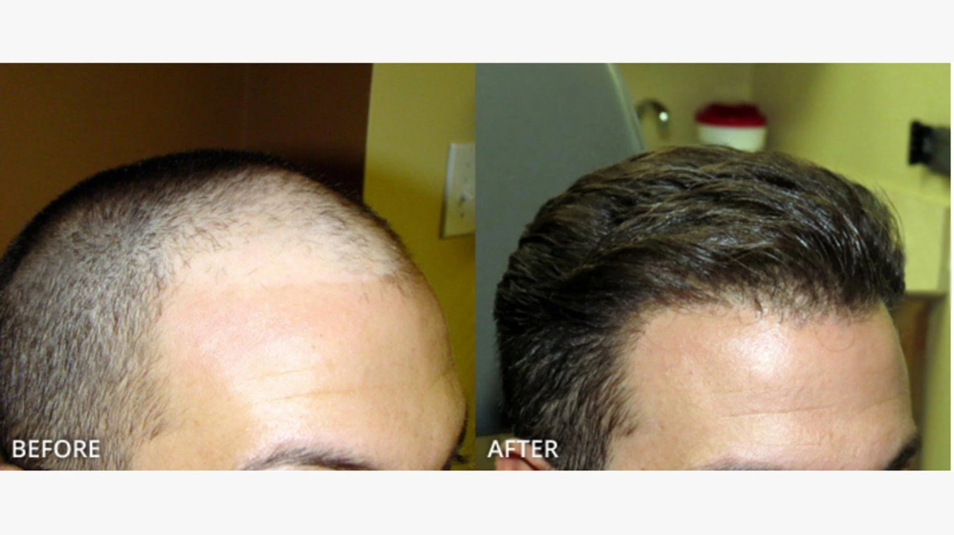 Seek consultation from hair transplant doctors