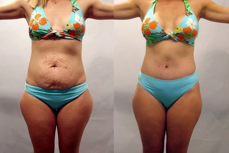 Reclaiming Confidence and Beauty: The Journey of a Mommy Makeover in Ireland