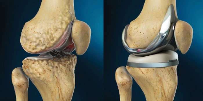 Reviving Mobility and Comfort: The Comprehensive Guide to Total Knee Replacement Surgery