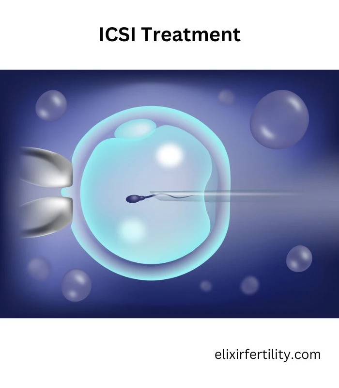 Navigating the Path to Parenthood: ICSI Treatment in Delhi with Elixir Fertility