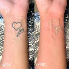 First Class Cosmetics removes exhausted colors by Tattoo removal NYC